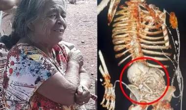 56 வருடங்களாக வயிற்றில் இருந்த இறந்த குழந்தை...உயிரிழந்த 81 வயது பெண்